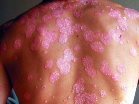 Psoriatik hastalık